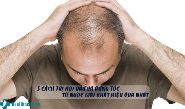 5 Cách trị hói đầu và rụng tóc từ nước giải khát tuyệt vời và hiệu quả