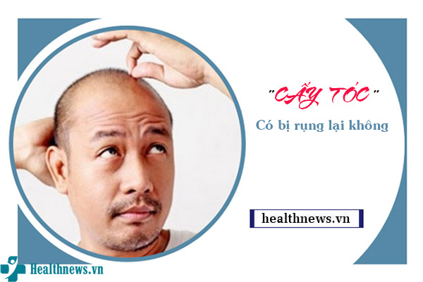 Cấy tóc có bị rụng lại không?