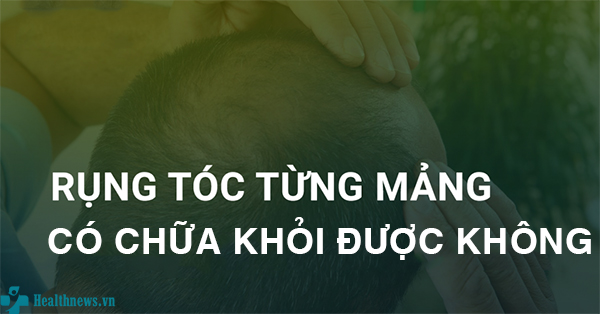 Bệnh rụng tóc từng mảng có chữa khỏi được không?