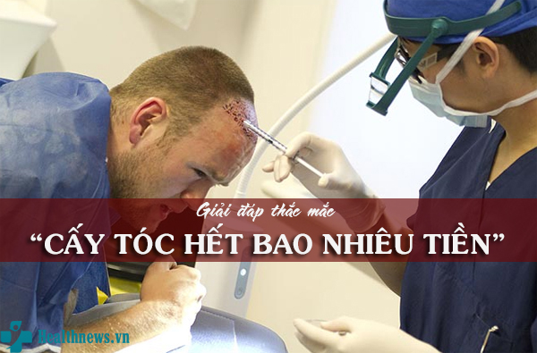 Cấy tóc là gì? Cấy tóc hết bao nhiêu tiền?