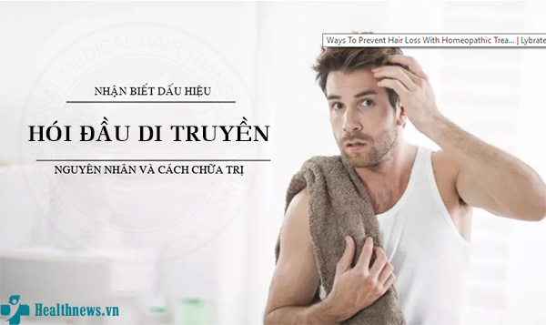 Hói đầu là gì? Nguyên nhân và cách chữa hói đầu di truyền hiệu quả nhất