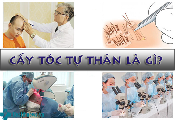 Cấy tóc tự thân – Phương pháp số 1 cho tình trạng rụng tóc, hói đầu