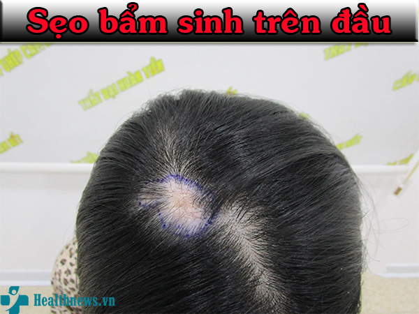 Bật mí cách “thủ tiêu” vết sẹo bẩm sinh trên đầu không để lại dấu vết