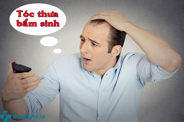 Hói đầu ở đàn ông có thể điều trị không  Vinmec