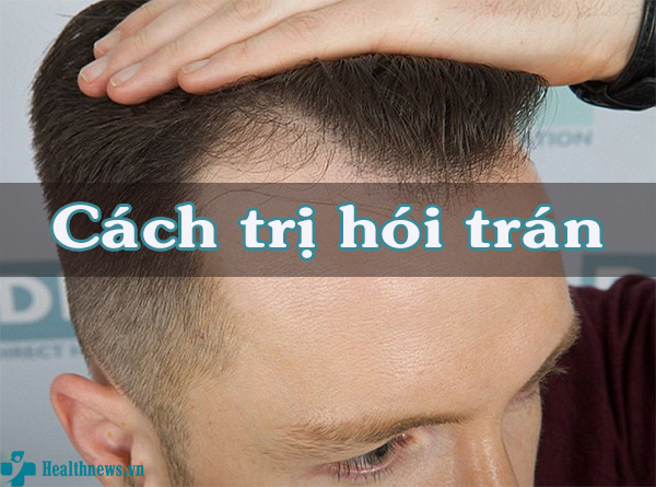 Phương pháp chống rụng tóc trị hói đầu cho nam giới