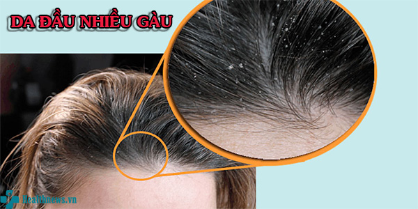 Mách bạn: 5 mẹo giúp loại bỏ da đầu nhiều gàu ngay tại nhà