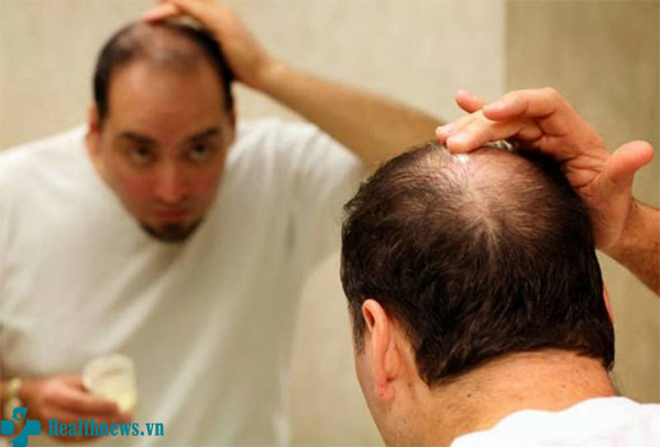 Thuốc trị hói đầu tốt nhất giành cho nam giới