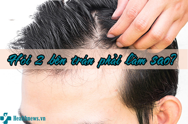 Hói 2 bên trán – Cách để điều trị dứt điểm