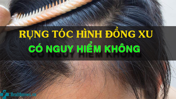 Rụng tóc hình đồng xu có nguy hiểm không? Cách khắc phục hiệu quả