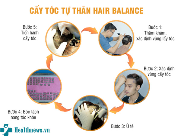Chi phí cấy tóc ở Hà Nội