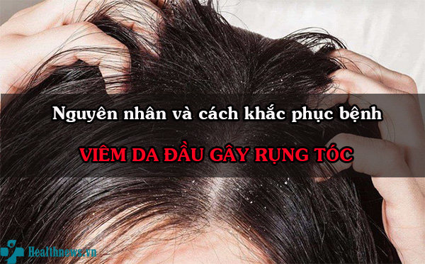 Viêm da đầu gây rụng tóc: Nguyên nhân do đâu, cách khắc phục thế nào?