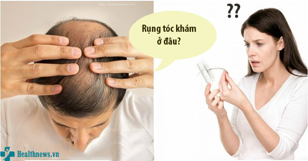 Khám rụng tóc ở đâu? Tổng hợp 10 địa chỉ khám chữa rụng tóc uy tín