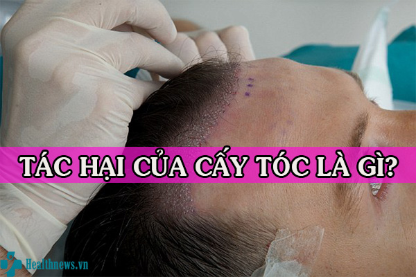 Có nên cấy tóc không? Tác hại của cấy tóc là gì?