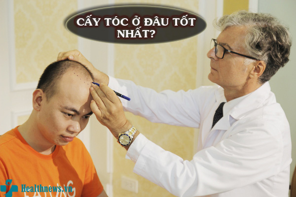 TÌM HIỂU: CẤY TÓC Ở ĐÂU TỐT NHẤT?