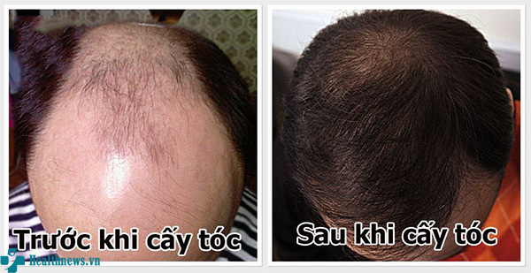 cách điều trị bệnh rụng tóc ở nam giới
