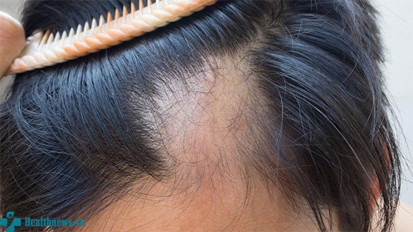 Rụng tóc thể mảng – Dấu hiệu, nguyên nhân và cách điều trị