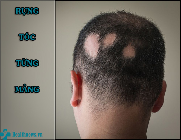 Rụng tóc từng mảng: Khắc phục nhanh trước khi hói đầu