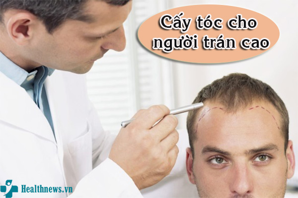 Tìm hiểu phương pháp cấy tóc cho người trán cao