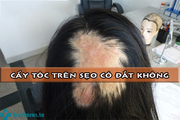 Chi phí cấy tóc chữa sẹo trên da đầu có đắt không?