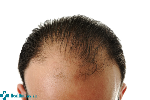 Rụng tóc 2 bên thái dương - Nguyên nhân và cách khắc phục