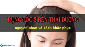 Rụng tóc 2 bên thái dương - Nguyên nhân và cách khắc phục