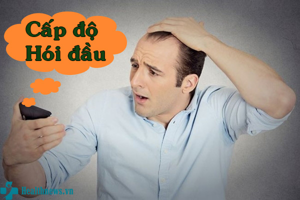 Cách nhận biết và điều trị theo các cấp độ hói đầu
