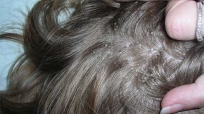 Chân tóc có hạt trắng