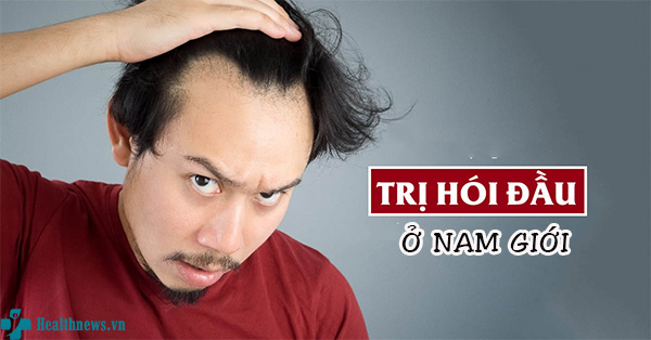 4 sai lầm dễ mắc khi trị hói đầu ở nam giới