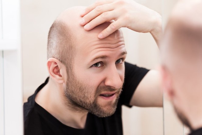 Cách trị hói trán tại nhà có hiệu quả không?