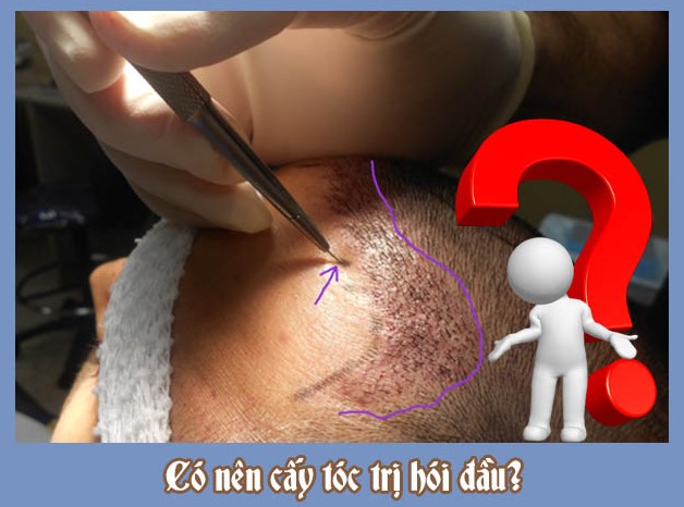 Cấy tóc có giúp chữa trị hói đầu triệt để?