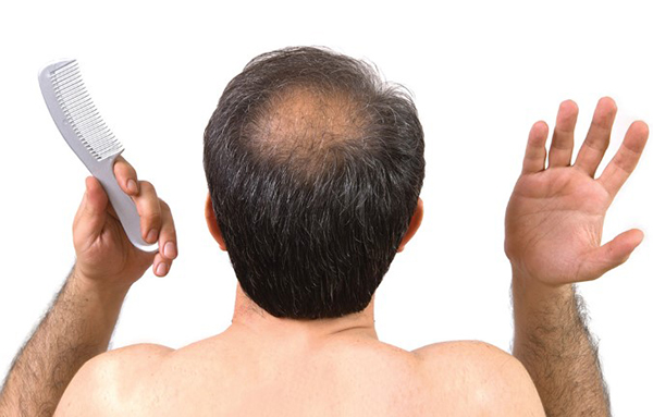 Những điều cần biết để khắc phục tóc thưa hói ở đỉnh đầu  Cấy Tóc Quốc Tế