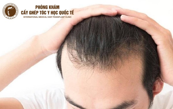 6 kiểu tóc cho trán cao nam thịnh hành che khuyết điểm dồ hói
