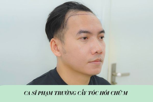 Ca sĩ Phạm Trưởng cấy tóc hói chữ M: Sự thay đổi nhỏ nhưng tác động lớn đến tâm lý người nghệ sĩ