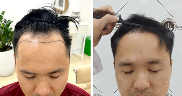 cấy tóc tự thân
