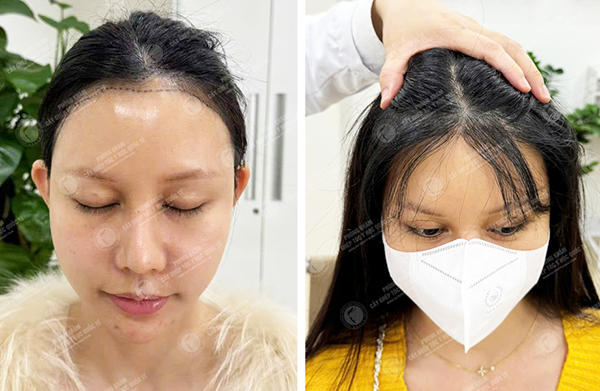 khách hàng được bác sĩ Lê Quang Vương thực hiện cấy tóc sợi dài pns