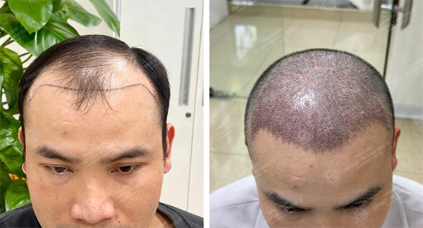 cấy tóc tự thân