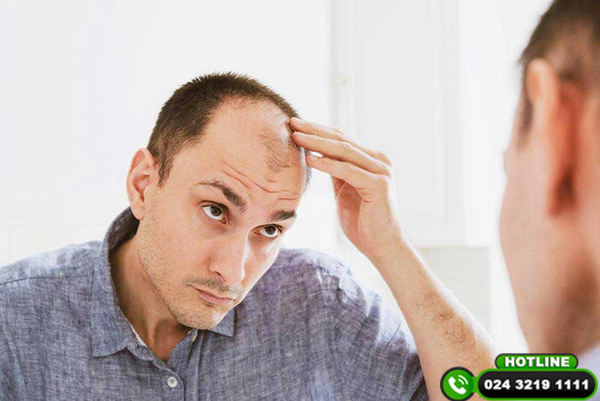 Tổng hợp các cách trị hói đầu di truyền hiệu quả hiện nay