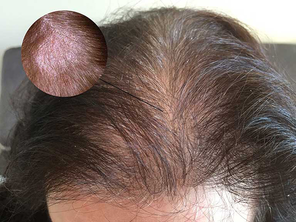 Bệnh viêm da đầu làm rụng tóc có thật sự nguy hiểm