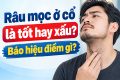 Râu mọc ở cổ là tốt hay xấu? Báo hiệu điềm gì?