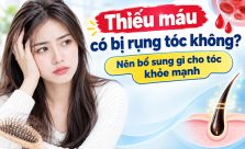Thiếu máu có bị rụng tóc không? Nên bổ sung gì cho tóc khỏe mạnh