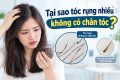 Tại sao tóc rụng không có chân tóc