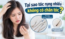 Tại sao tóc rụng không có chân tóc