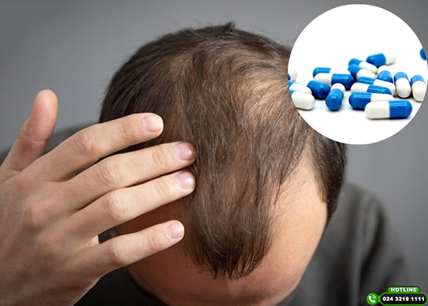Uống gì để tóc hết rụng ở nam giới? Top 5 loại thuốc được ưu dùng