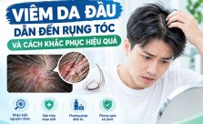 Viêm da đầu dẫn đến rụng tóc và cách khăc phục hiệu quả