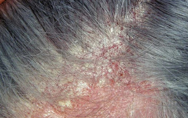 Viêm da đầu tiết bã nhờn