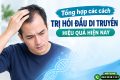 Tổng hợp các cách trị hói đầu di truyền hiệu quả hiện nay