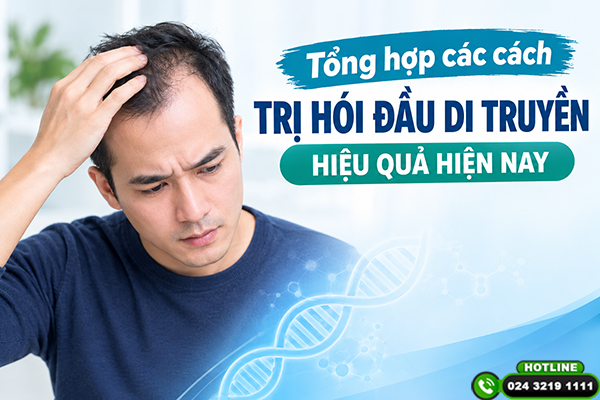 Tổng hợp các cách trị hói đầu di truyền hiệu quả hiện nay