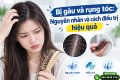 Bị gàu và rụng tóc: Nguyên nhân và cách điều trị dứt điểm