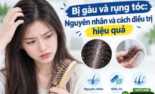 Bị gàu và rụng tóc: Nguyên nhân và cách điều trị dứt điểm