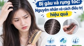 Bị gàu và rụng tóc: Nguyên nhân và cách điều trị dứt điểm